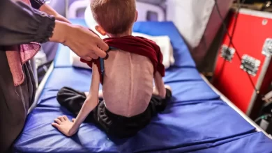 ارتفاع عدد الشهداء من الأطفال نتيجة سوء التغذية إلى 66