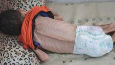 18 وفاة خلال 24 ساعة بسبب الجوع في غزة