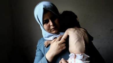 الأونروا: واحد من كل خمسة أطفال في غزة يعاني سوء التغذية