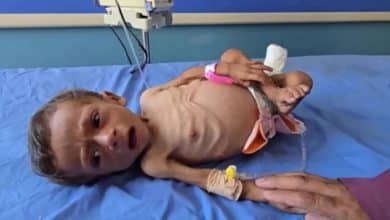 متلازمة "غيلان باريه" القاتلة في غزة.. شلل بطيء يهدد حياة الأطفال