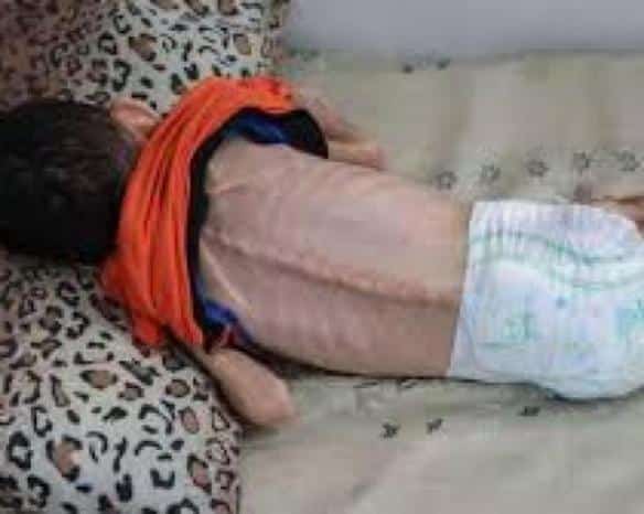 استشهاد طفل في قطاع غزة جراء المجاعة وسوء التغذية